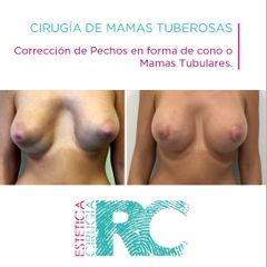 Mamas tuberosas - Rc Estética