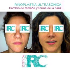 Rinoplastia - Rc Estética