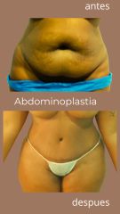 Abdominoplastia - Rc Estética