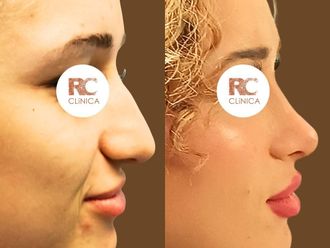 Rinoplastia antes y después - 877711