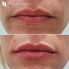 Aumento de labios - Alta Estética