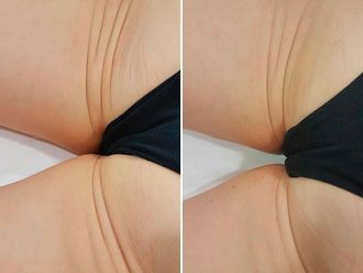 Carboxiterapia antes y después - 796401
