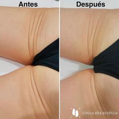 Carboxiterapia - Alta Estética