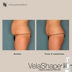 Celulitis - Alta Estética
