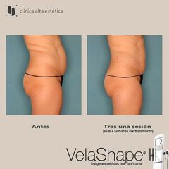 Celulitis - Alta Estética