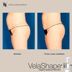 Celulitis - Alta Estética