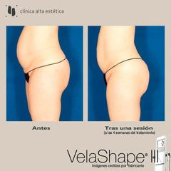 Celulitis - Alta Estética