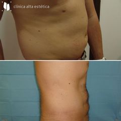 Liposucción - Alta Estética