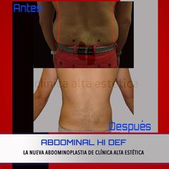 Abdominoplastia - Alta Estética