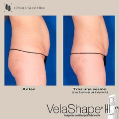 Celulitis - Alta Estética