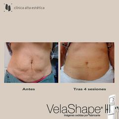 Celulitis - Alta Estética