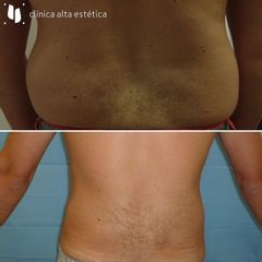 Liposucción - Alta Estética