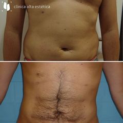 Liposucción - Alta Estética