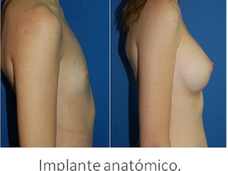 Antes y después aumento de pecho : Prótesis anatomica, 355cc