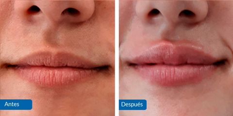 Aumento de labios - Clínica Barbero