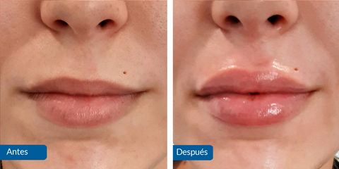Aumento de labios - Clínica Barbero