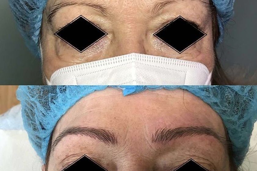 Microblading antes y después - 786106