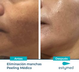 Eliminación de manchas faciales - Clínicas Estymed