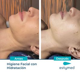 Tratamiento antiacné - Clínicas Estymed