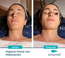 Rejuvenecimiento facial - Clínicas Estymed
