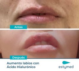 Aumento de labios - Clínicas Estymed