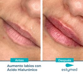Aumento de labios - Clínicas Estymed