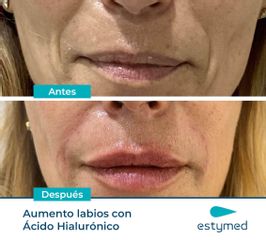 Aumento de labios - Clínicas Estymed