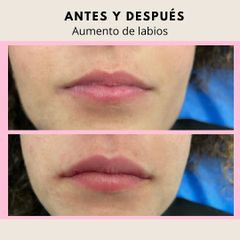 Aumento de labios - Clínica Freire