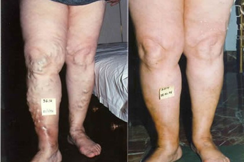Tratamiento varices antes y después - 418765