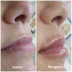 Aumento y perfilado de labios - Clínica Médica Villa Teresa