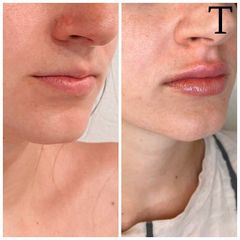 Aumento de labios - Clínica Trevi