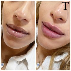 Aumento de labios - Clínica Trevi