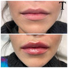 Aumento de labios  - Clínica Trevi