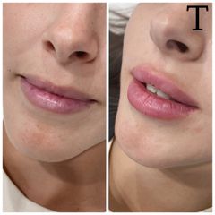 Aumento de labios  - Clínica Trevi