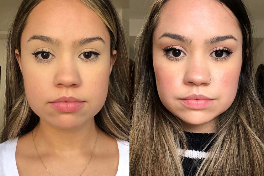 Bichectomía antes y después - 846587