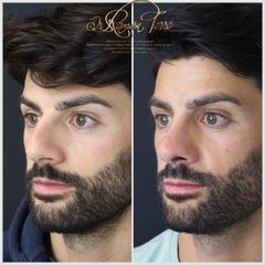 Rinoplastia - Dr. Ramón Terré Falcon