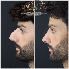 Rinoplastia - Dr. Ramón Terré Falcon