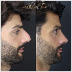 Rinoplastia - Dr. Ramón Terré Falcon
