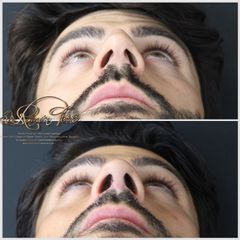 Rinoplastia - Dr. Ramón Terré Falcon