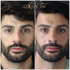 Rinoplastia - Dr. Ramón Terré Falcon