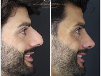 Rinoplastia antes y después - 880564