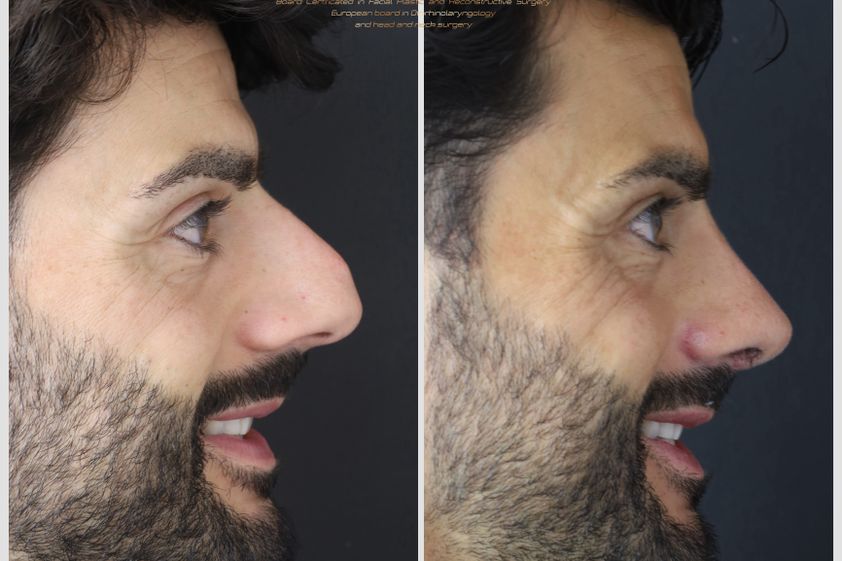 Rinoplastia antes y después - 880564