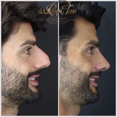 Rinoplastia - Dr. Ramón Terré Falcon