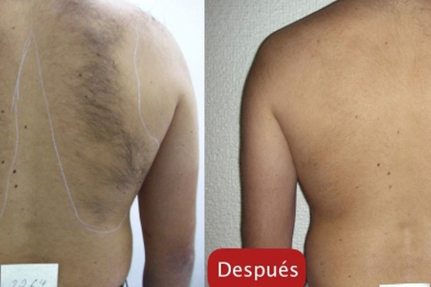 Depilación láser antes y después - 509137