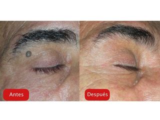 Antes y después Eliminación de verrugas