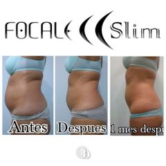 HIFU - Bellest