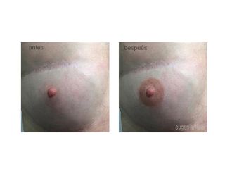 Antes y después Micropigmentación pezones
