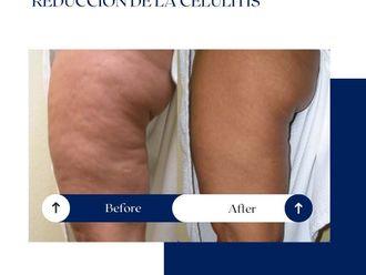 Celulitis antes y después - 875062