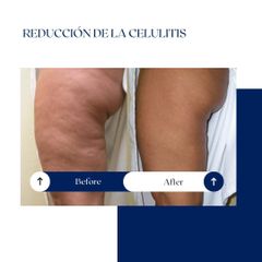 Ghorchi Clinic - Celulitis