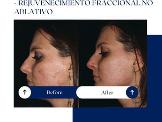 Rejuvenecimiento facial antes y después - 875063